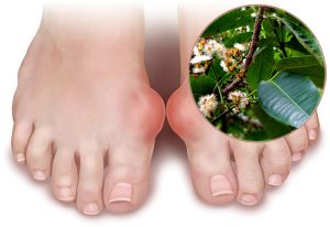 Các phương pháp điều trị bệnh Gout