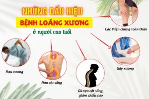 Dấu hiệu của người bị loãng xương