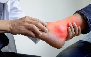 Đối tượng có nguy cơ mắc bệnh Gout